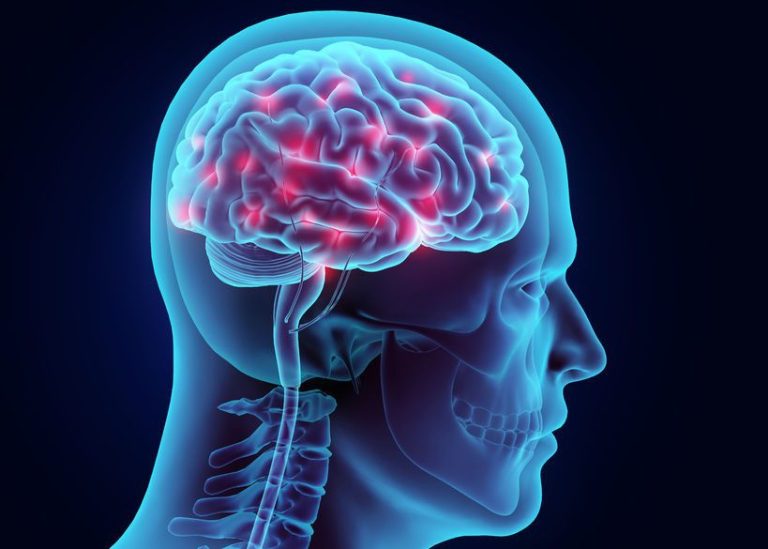 Fakta Medis Seputar Stroke Panduan Lengkap Memahami Dan Mencegah Serangan Otak
